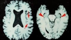 Brain disease in dead NFL players 'higher than previously shown'